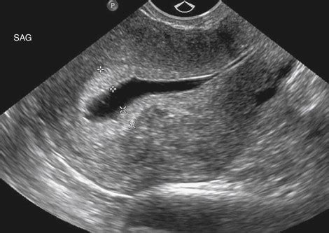 The Normal Pelvis on Ultrasound Imaging and Anatomic Correlations | Radiology Key