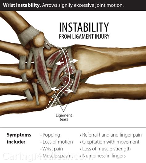 Snapping wrist – the extensor carpi ulnaris (ECU) tendon; the extensor pollicis brevis; and the ...