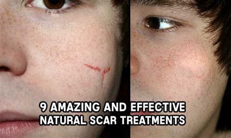 9 Amazing And Effective Natural Scar Treatments – iSeeiDoiMake