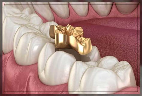 Gold Fillings: Pros and Cons - Engiomed