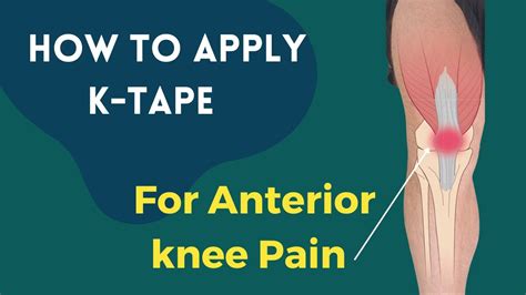 How to apply Kinesiology tape for knee pain - Patella Femoral Syndrome ...