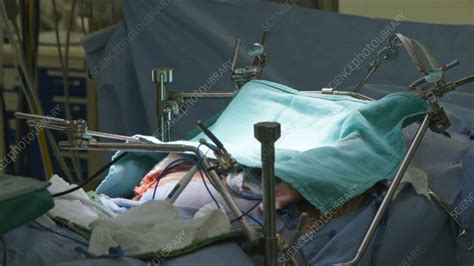 Organ transplant surgery - Stock Video Clip - K008/4730 - Science Photo Library