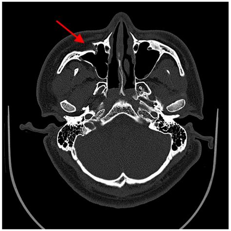 JCM | Free Full-Text | Risk Factors for Maxillary Sinus Pathology after ...