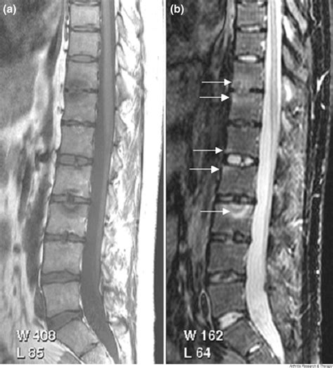 Magnetic resonance imaging in psoriatic arthritis: a review of the ...