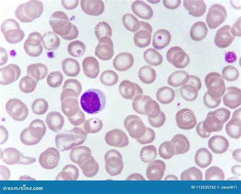 Lymphocyte Cell in Blood Smear Stock Photo - Image of eosinophil ...