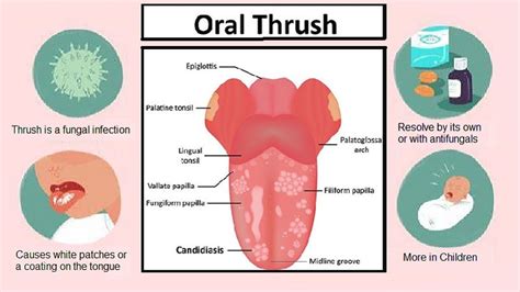 Thrush (Yeast infection): Causes and Treatment - Helal Medical