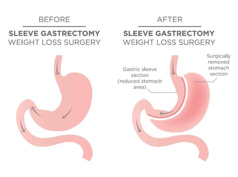 Vertical Sleeve Gastrectomy/Gastric Sleeve Surgery Gold Coast