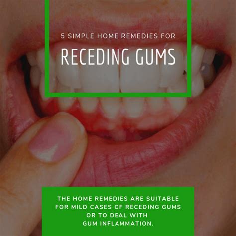 5 Simple Home Remedies For Receding Gums