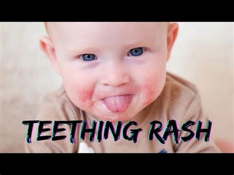 What teething rash looks like and how to treat. Teething can hurt, causing babies to become ...