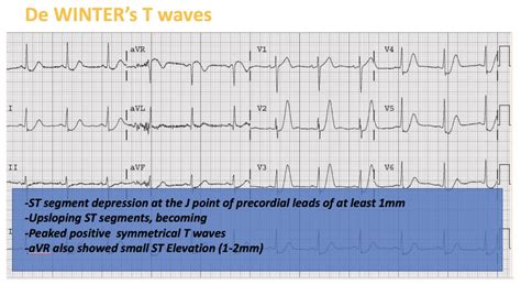 de Winters T Waves - CARDIAC BOOTCAMP