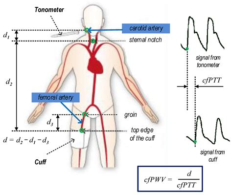 Femoral Pulse Landmark