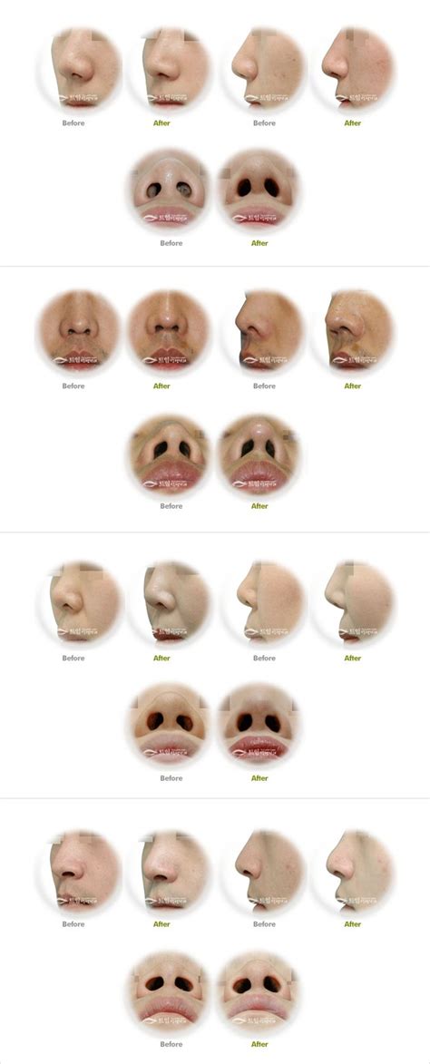 A charming example of nose shapes from a plastic surgeon's website. | Nose shapes, Nose makeup ...