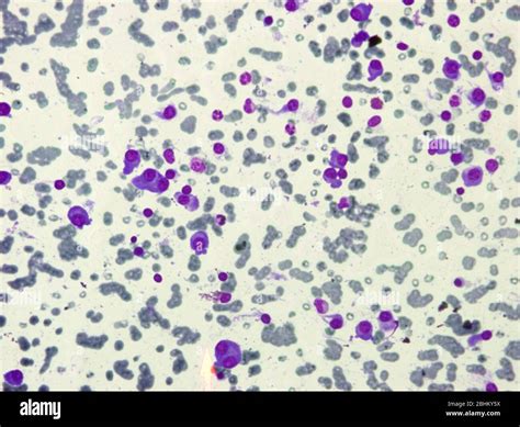 Multiple myeloma cells hi-res stock photography and images - Alamy