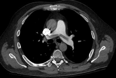 Pulmonary embolism: Presentation, Diagnosis and Treatment