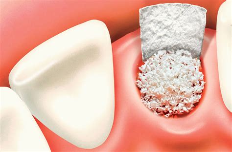 socket-graft-alveolar-ridge-preservation-graft - Pacific Oral Surgery