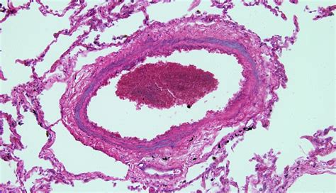 Pediatric PAH Prognosis Predicted by WHO Functional Class - The Cardiology Advisor