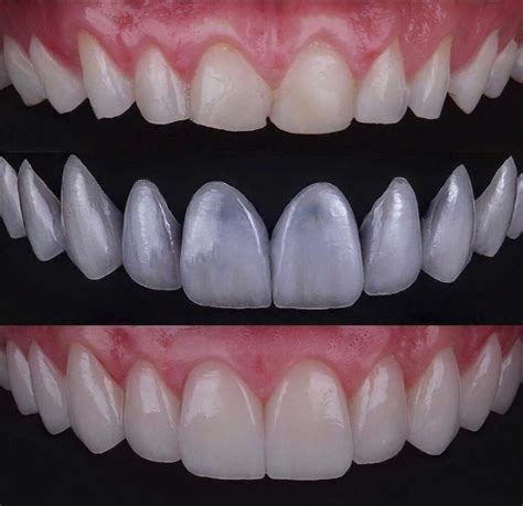 Veneers Teeth Turkey at Janice Unger blog