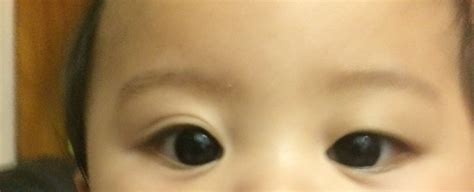 Uneven Eye Size | BabyCenter