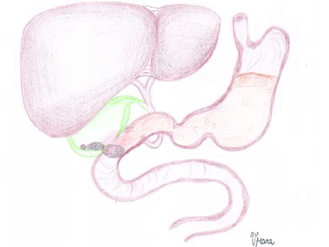 Illustration of the cholecystoduodenal fistula | Download Scientific Diagram