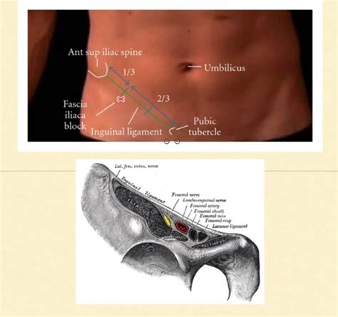 Fascia Iliaca Compartment Block — Downeast Emergency Medicine