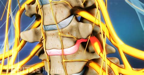 See what a cervical herniated disc looks like and understand its symptoms, causes and treatments ...