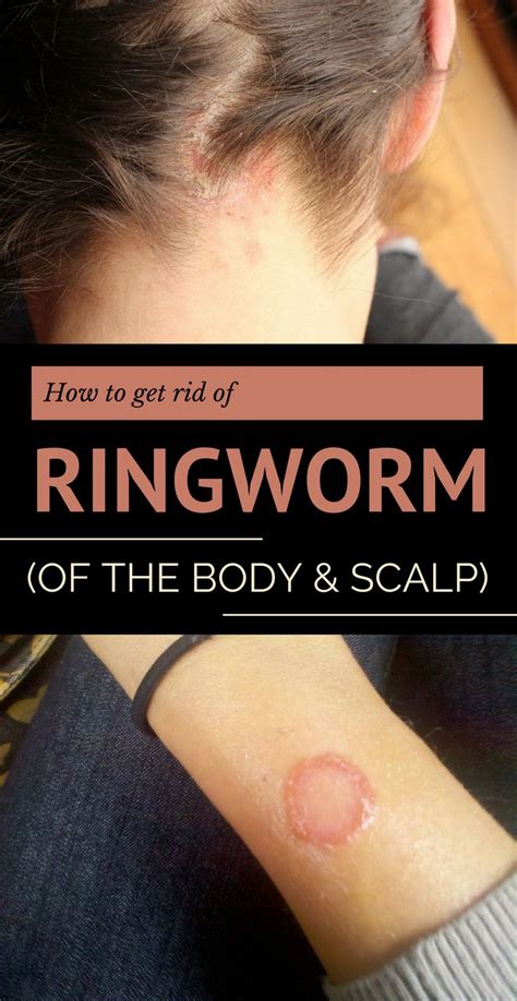 How to Get Rid of Ringworm (of the Body and Scalp) | Get rid of ...