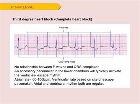 ECG Complete Heart Block Strip