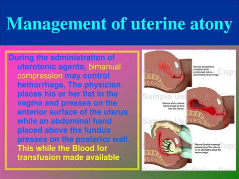 PPT - Postpartum Complications PowerPoint Presentation, free download ...