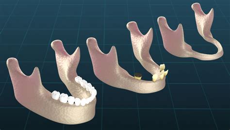 What are the Causes of Bone Loss in the Jaw?