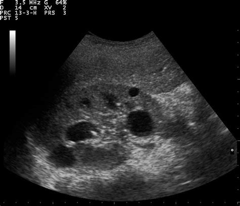 Difference Between Nodule and Cyst | Compare the Difference Between ...