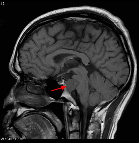 Chordoma Cancer - Causes, Symptoms, Life Expectancy, Treatment