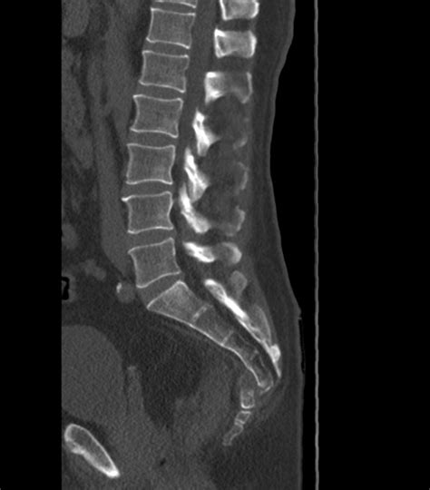 Coccygeal Fracture. - NeuroRad911 Coccygeal fracture