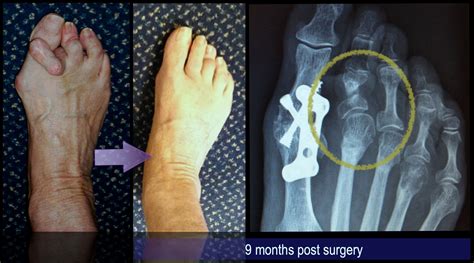 Minimally Invasive Lesser Toe Surgery | David Redfern Surgery