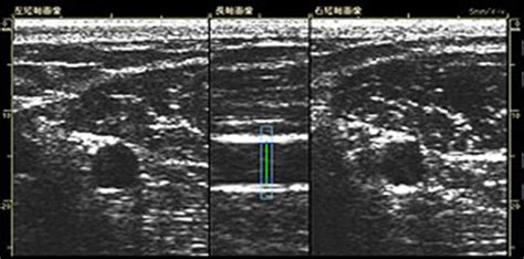 Representative ultrasound image of the brachial artery. Both side ...