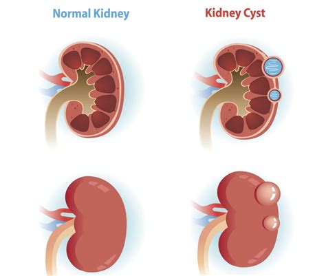 Treatments for Kidney Cysts - Facty Health