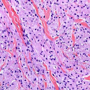 Granular Cell Tumor | Basicmedical Key