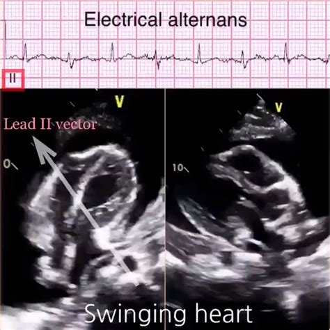 Electrical Alternans Demonstrated on POCUS [Clinical] : r/medicalschool