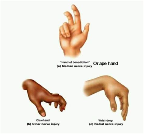 Claw Hand Cause,Symptom,Diagnosis,Physiotherapy Treatment | atelier ...