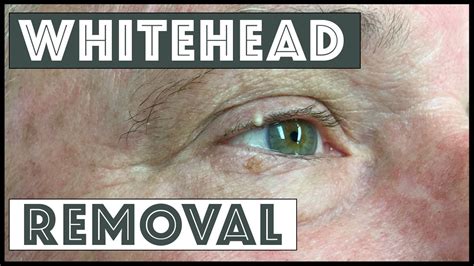 Removing a whitehead from the conjunctival rim - YouTube