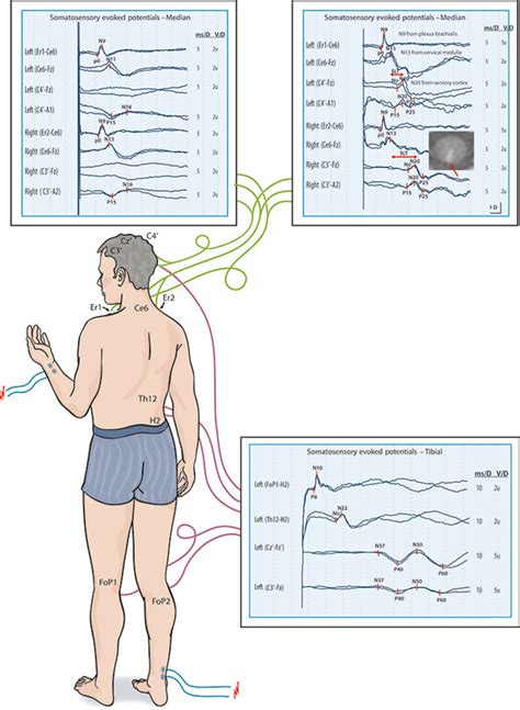 Evoked potential tests in clinical diagnosis | Tidsskrift for Den norske legeforening