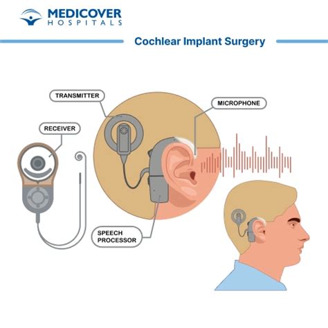 Cochlear Implant Surgery - Benefits, Indications and Procedure