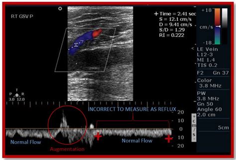 What's wrong with this image? Venous Reflux Cardioserv