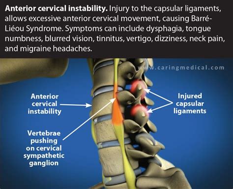 Cervical Instability | Cervical radiculopathy, Cervical, Vertigo treatment