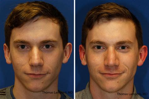 Bulbous Tip | Rhinoplasty in Seattle