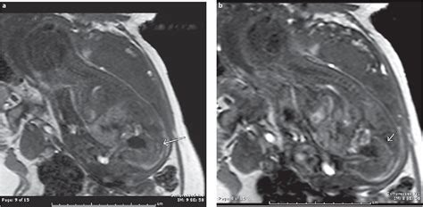 Figure 4 from Prenatal MRI Diagnosis of Hirschsprung's Disease at 29 Weeks' Gestational Age in a ...