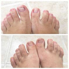 24 Dry Brittle Toenails Essential Oils ideas | oils, essential oils ...