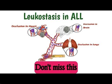 Leukostasis | Leukostasis in Acute Lymphoblastic Leukemia | Leukostasis ...