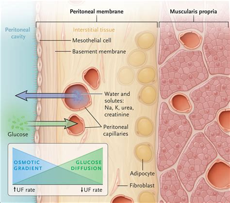 Peritoneal Dialysis | New England Journal of Medicine