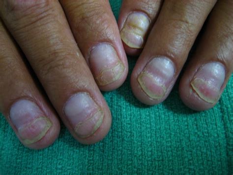 Share more than 145 dents in nails causes - ceg.edu.vn