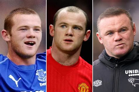 Great Hair Transplant Journey Wayne Rooney